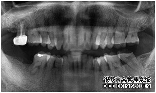 牙齿拍片初步检查